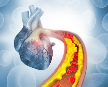 Cholesterol and heart disease